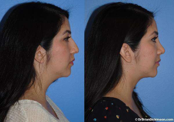 Correcting A Dorsal Hump - Primary Rhinoplasty Dorsal Hump Before and After