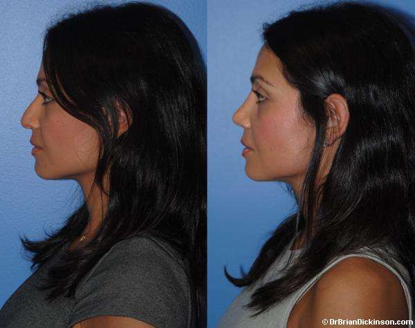 Female Middle Eastern Primary Rhinoplasty Newport Beach