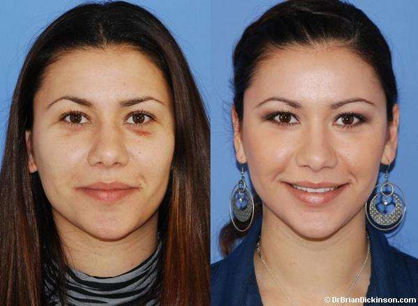 Rhinoplasty Before and After Photos in Newport Beach