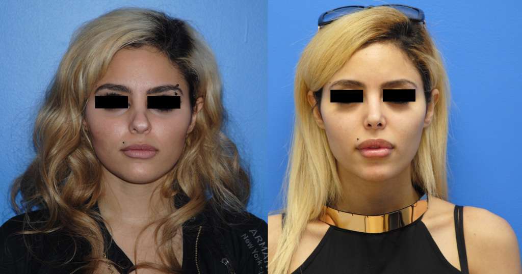 Middle Eastern Secondary Rhinoplasty Before and After Photos
