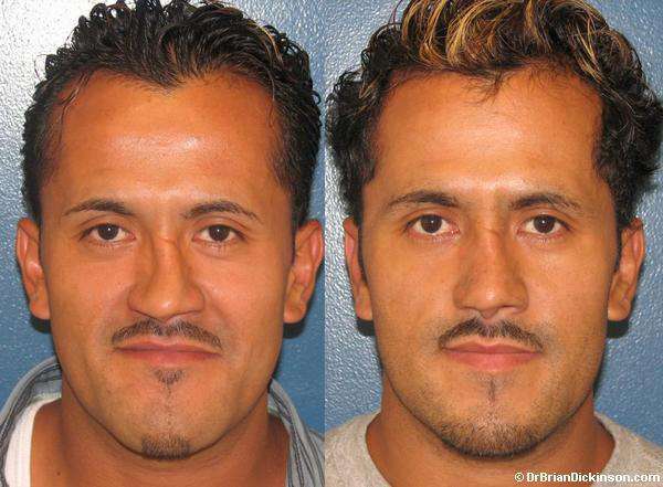 Revision Rhinoplasty of Deviated Septum in Newport Beach