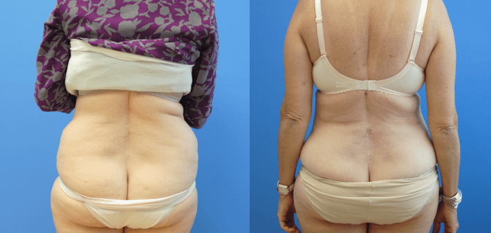 Liposuction of Lower Back