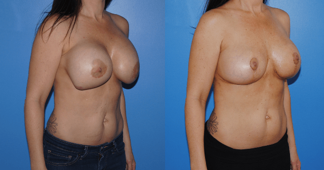 Mastopexy-Removal-Replacement-Saline - Brian Dickinson, M.D.