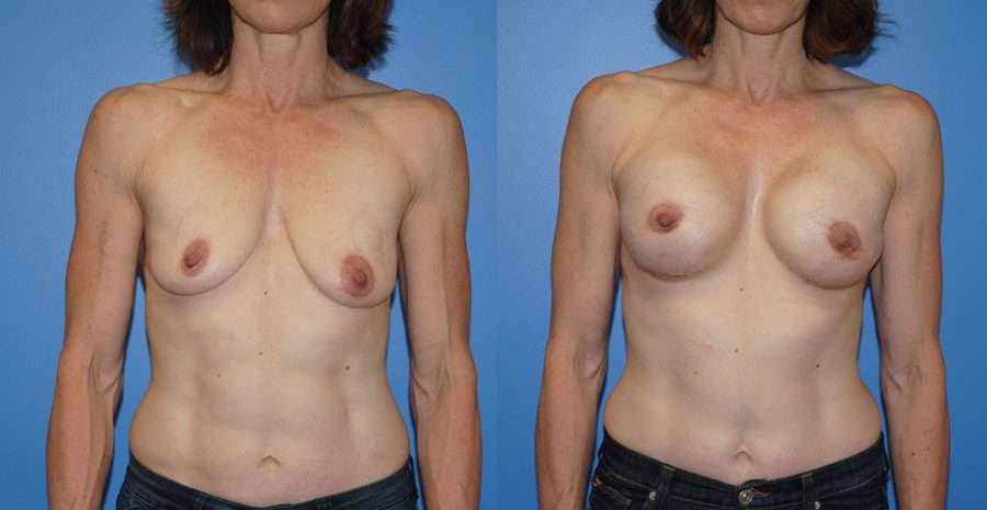 Breast Reconstruction Before and After images