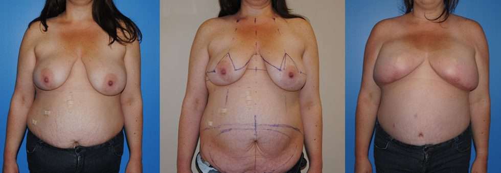 DIEP flap breast reconstruction