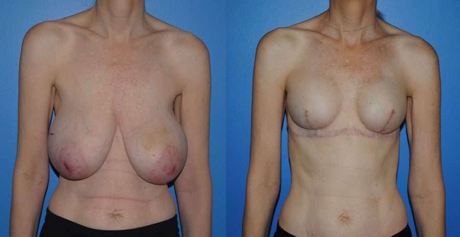 Breast reconstruction following mastectomy with tissue expander and implant reconstruction