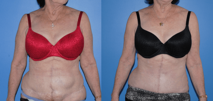 Abdominal Wall Reconstruction with Component Separation and Strattice