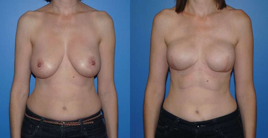 Implant breast reconstruction before and after following mastectomy