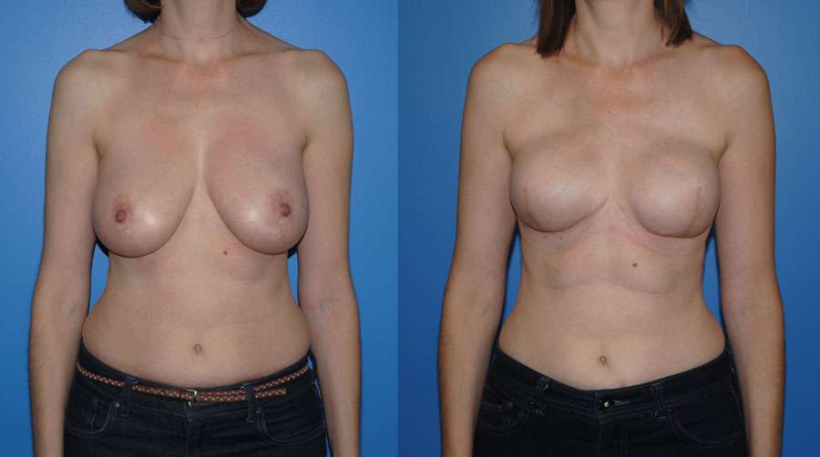 Implant breast reconstruction before and after following mastectomy