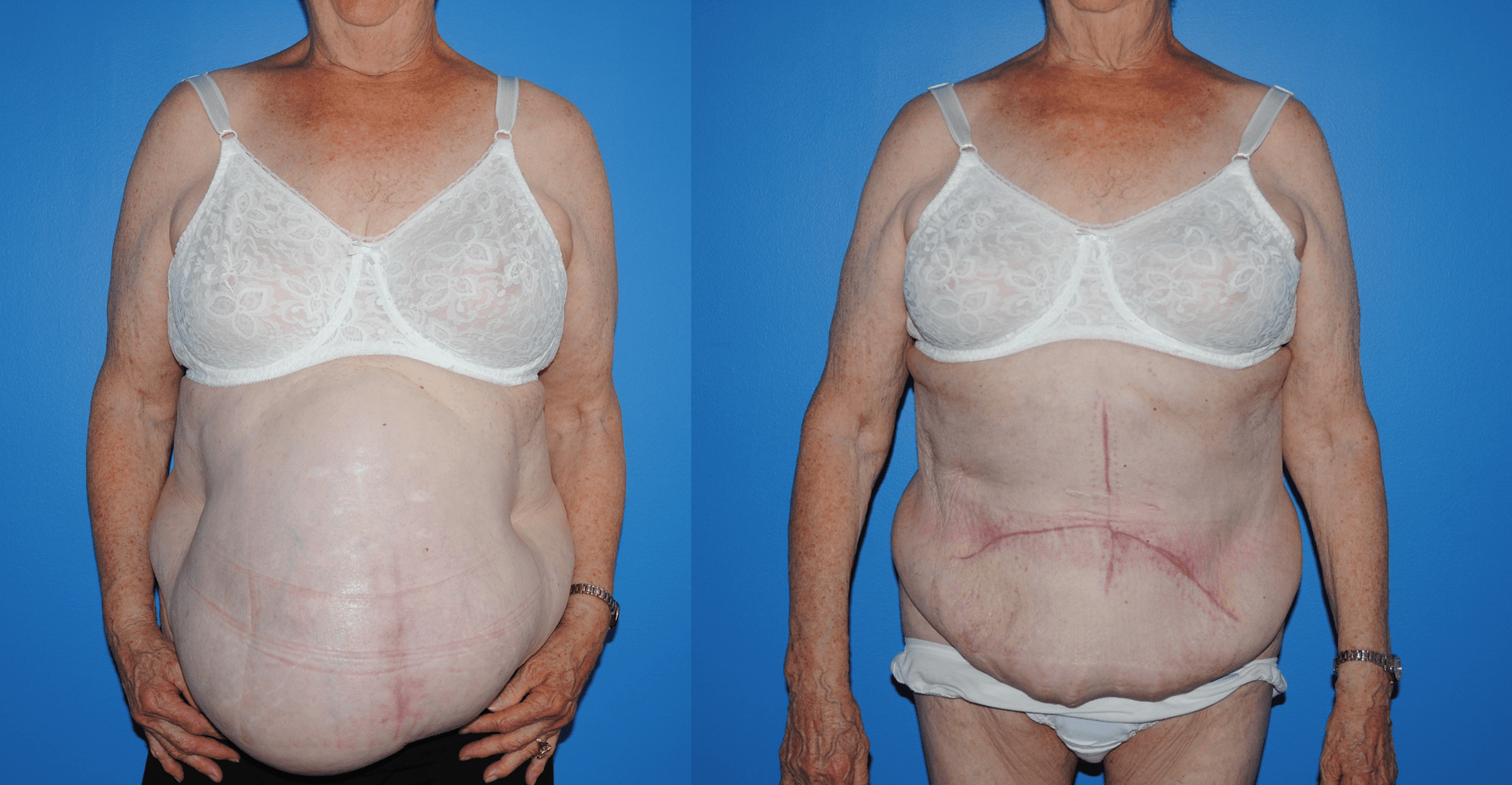 Hernia Repair with Component Separation and Strattice