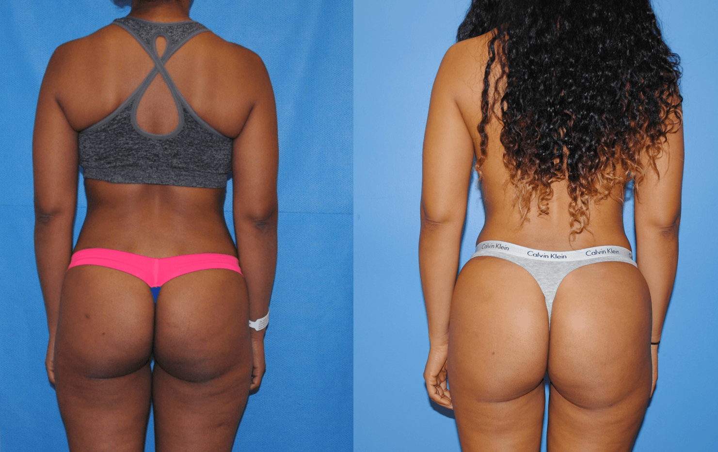Liposuction and Gluteal Fat Transfer