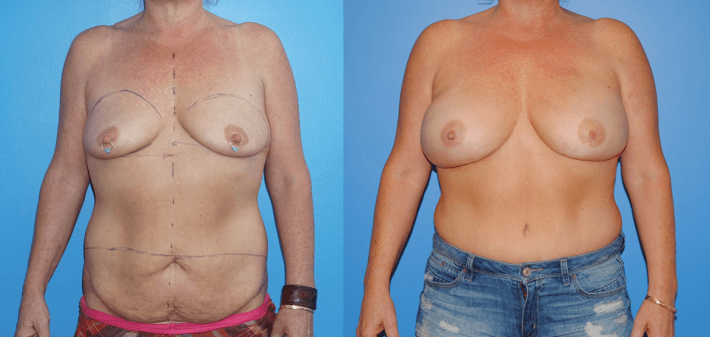 Displays DIEP Flap Reconstruction following bilateral mastectomy