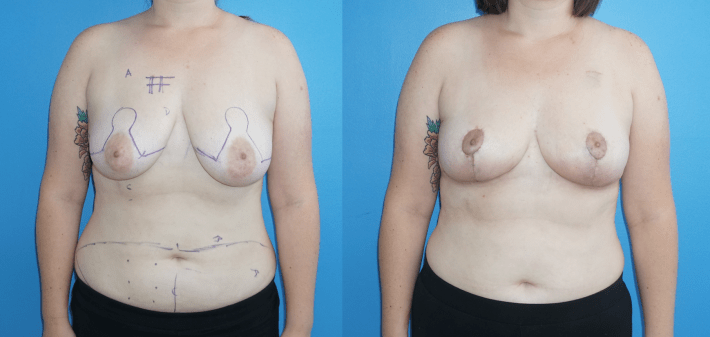 Oncoplastic Reconstruction following Lumpectomy and DIEP Flap Reconstruction Following Mastectomy