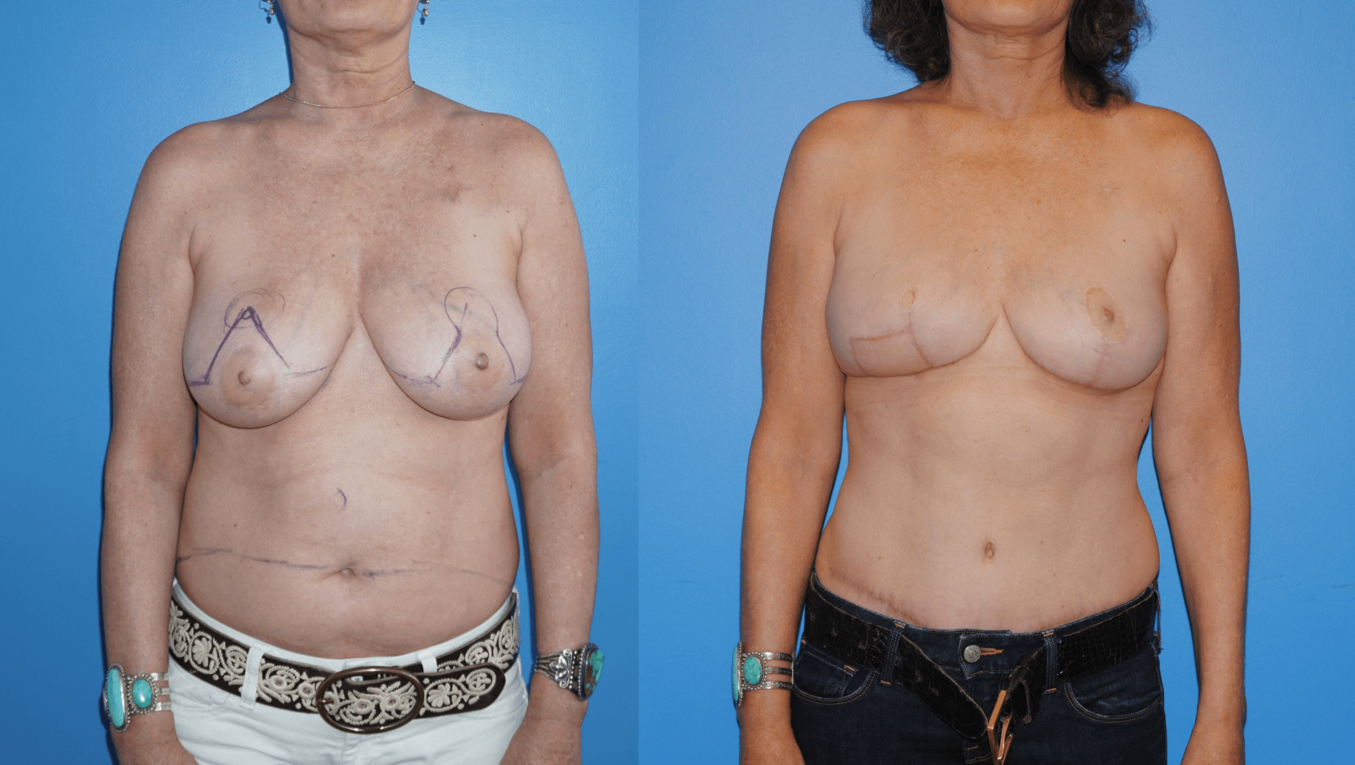 Displays Unilateral Breast DIEP Flap reconstruction and contralateral mastopexy
