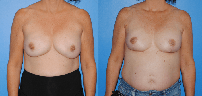 Mastectomy Reconstruction