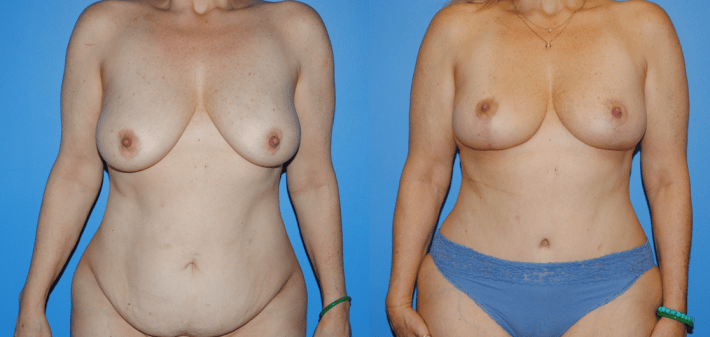 Abdominoplasty-Belly Button