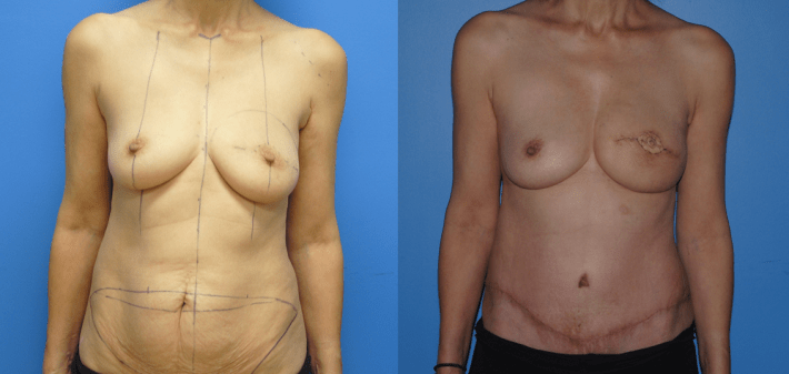 DIEP Flap post Mastectomy with previous Lumpectomy and Radiation