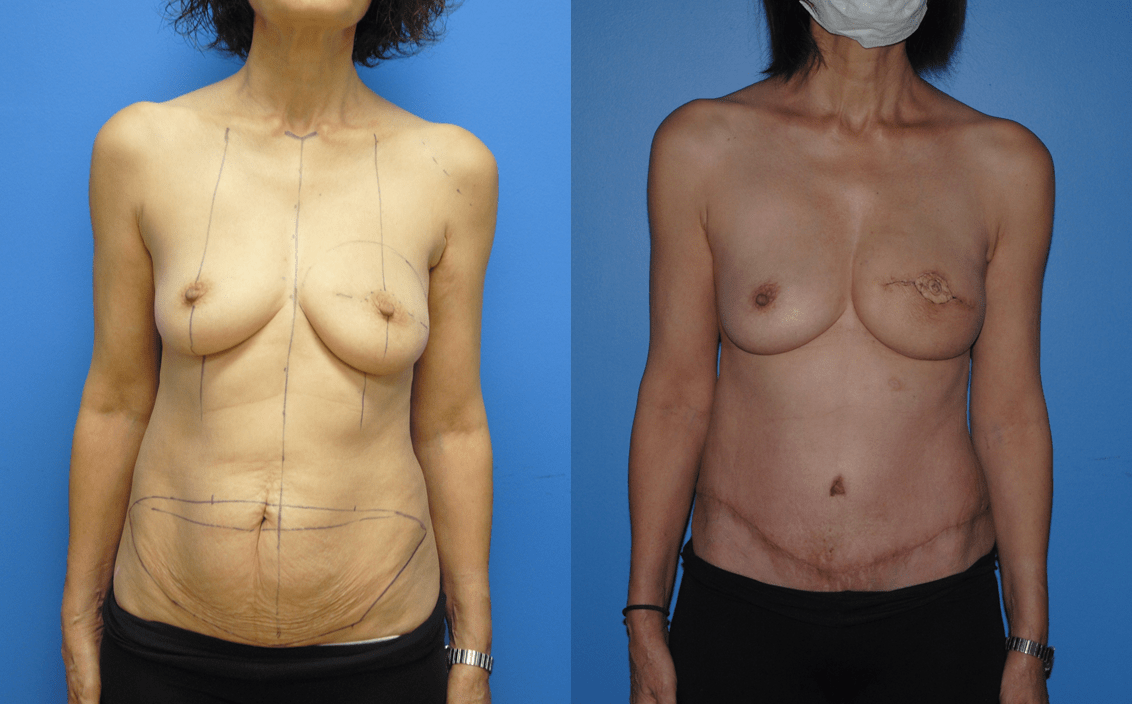 DIEP Flap post Mastectomy with previous Lumpectomy and Radiation