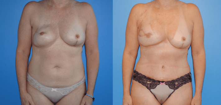 Unilateral DIEP Flap Breast Reconstruction