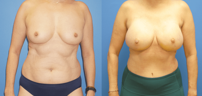 DIEP Flap Reconstruction and Mammary Prosthesis