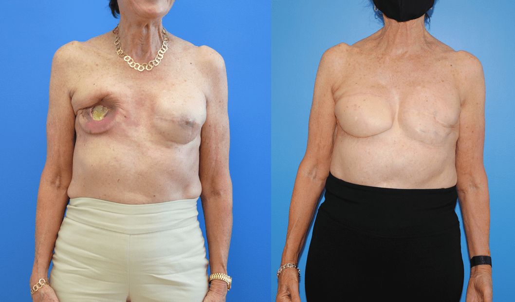 Breast Reconstruction Post Radiation