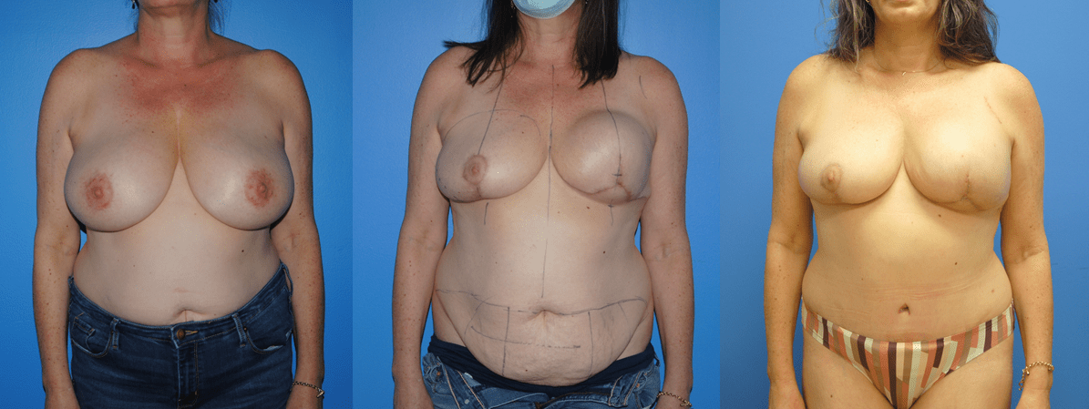 DIEP Flap Reconstruction Following Tissue Expander and Mastectomy