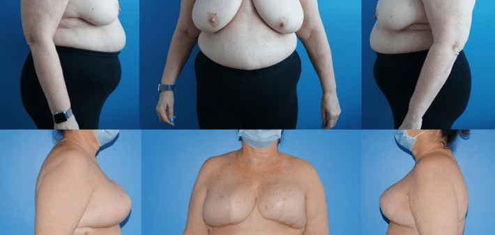 DIEP Flap Results and Weight Loss