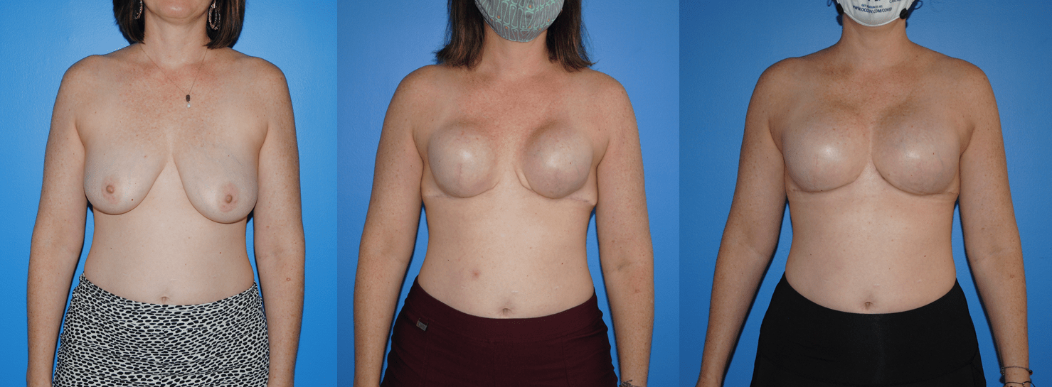 Tissue Expander-Breast Implant Reconstruction