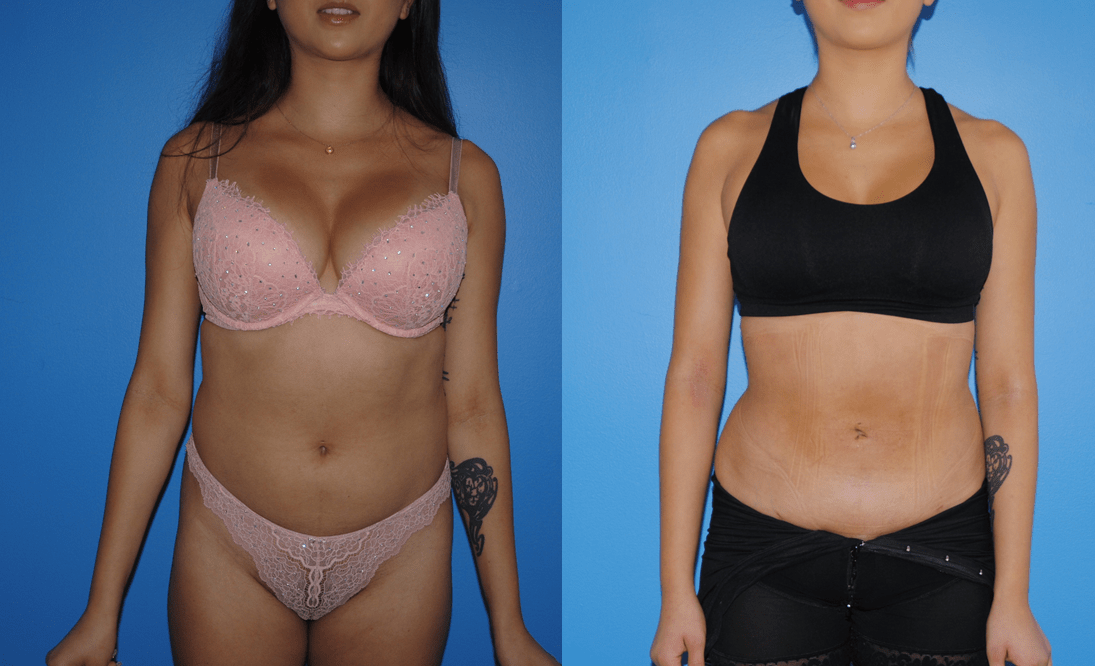 Liposuction of Abdomen for Fat Transfer