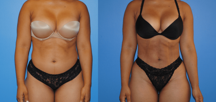 Liposuction of Abdomen with Gluteal Fat Transfer