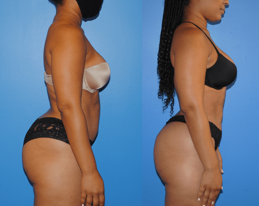Liposuction of Abdomen-Gluteal Fat Transfer