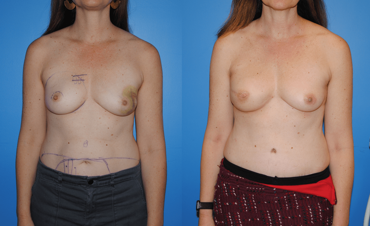 Unilateral DIEP Flap Breast Reconsruction