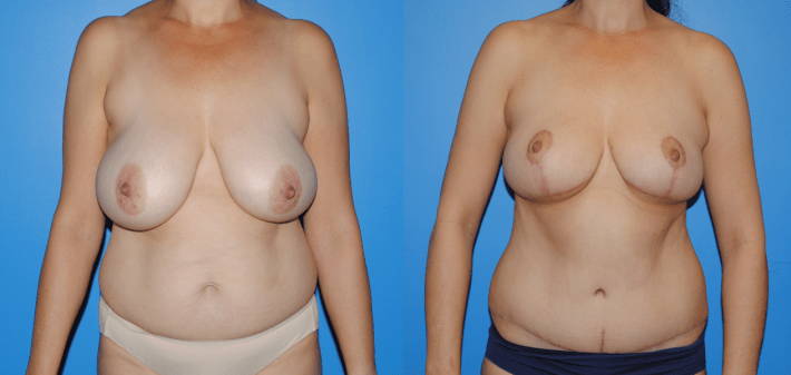 Belly Button-Abdominoplasty