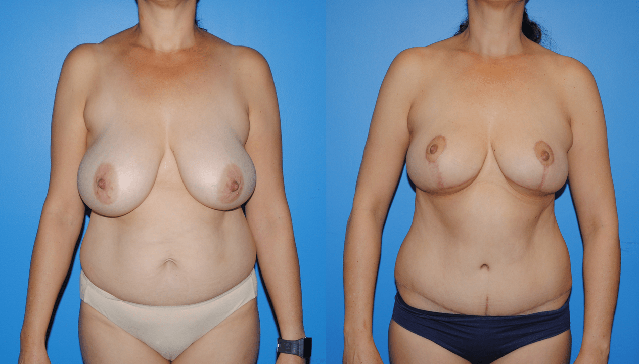 Belly Button-Abdominoplasty