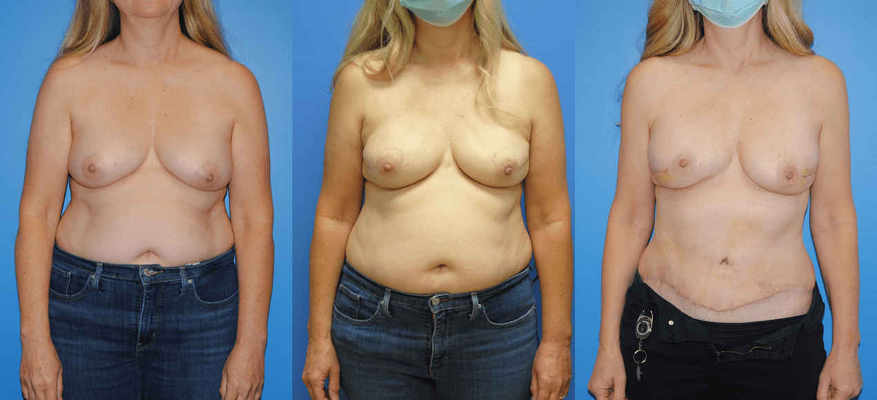 DIEP Flap Breast Reconstruction-Brian Dickinson, M.D.