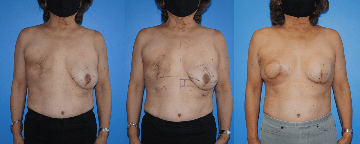 Latissimus Dorsi Mastectomy Reconstruction