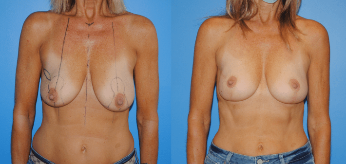 Oncoplastic Reconstruction of Lumpectomy Defects