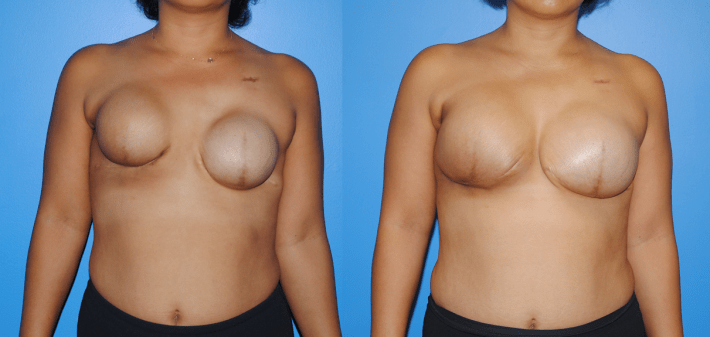 Tissue Expander and Implant Breast Reconstruction