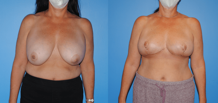Onccoplastic Reconstruction of Lumpectomy Defects and Removal of Mammary Prosthesis