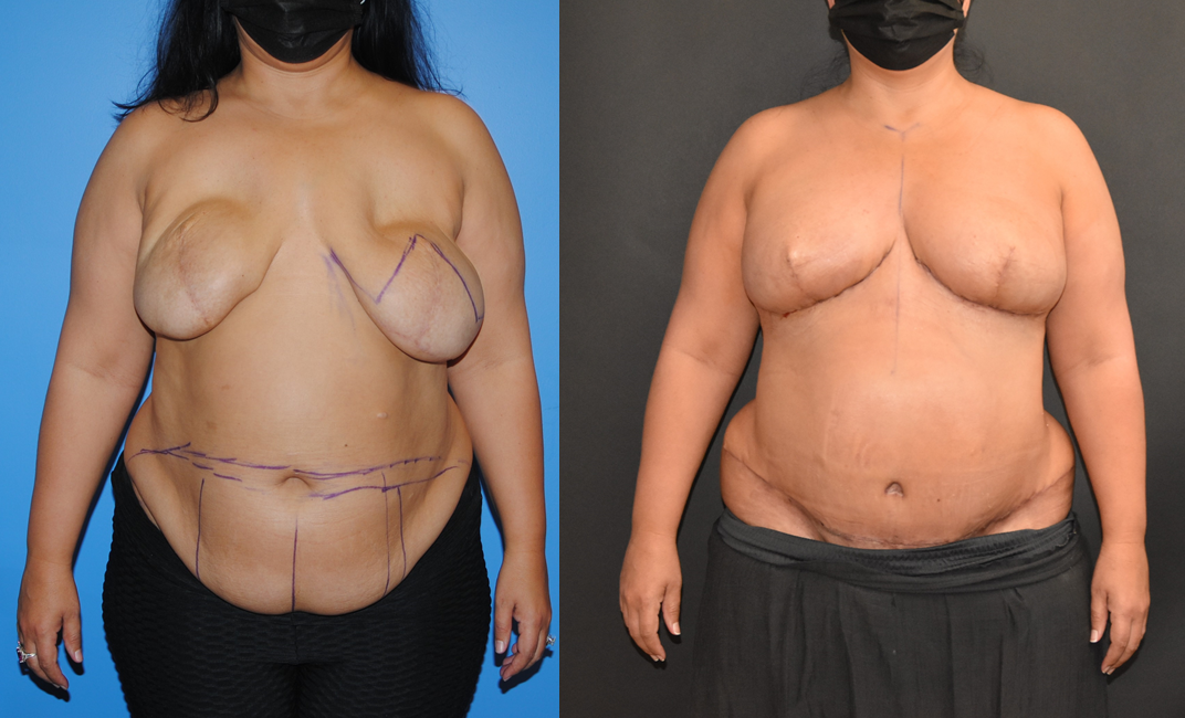 DIEP flap Breast Reconstruction after Implant Removal