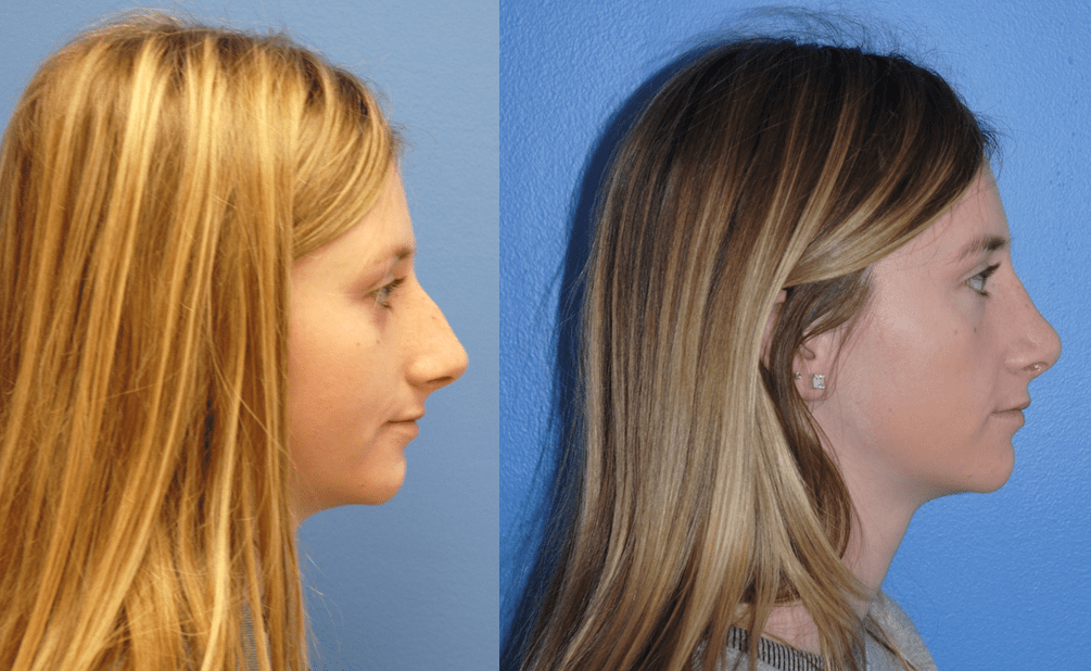 Dorsal Hump Reduction in Rhinoplasty with Natural Results