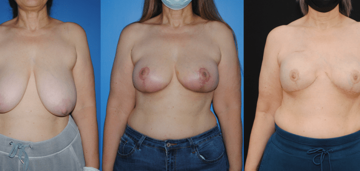 Implant Based Breast Reconstruction