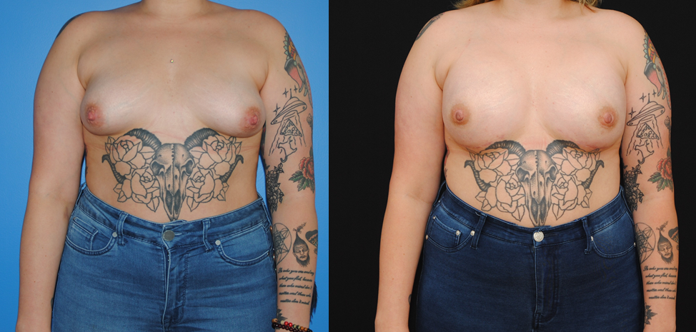 Bilateral Implant Breast Reconstruction