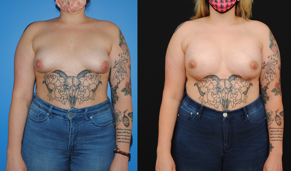 Bilateral Implant Breast Reconstruction
