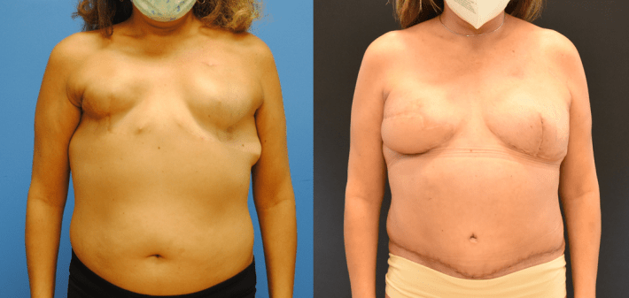 Bilateral DIEP Flap Reconstruction with Oncoplastic Mastectomy