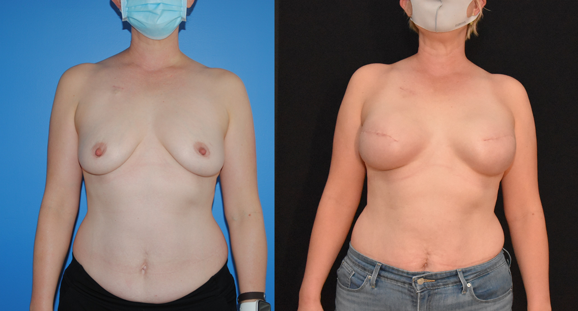 Tissue-Expander and Breast Implant Reconstruction following Mastectomy