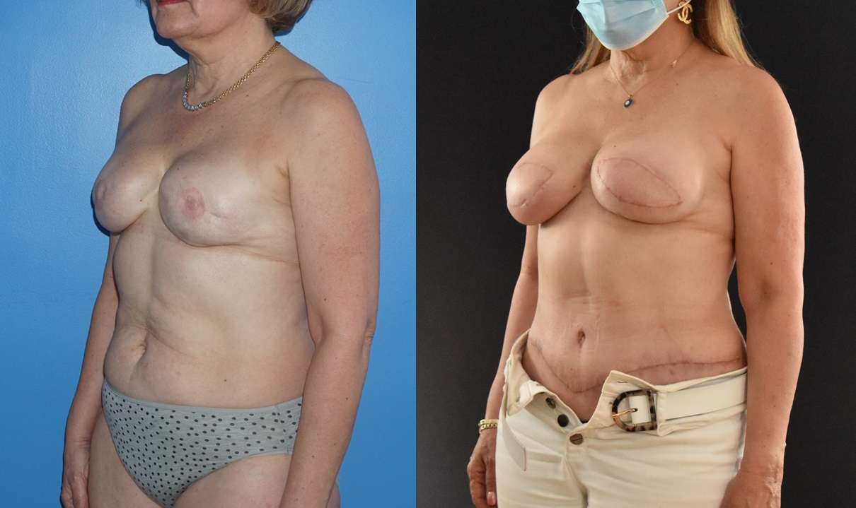 Display improvement of Breast Reconstruction with removal of implants and bilateral DIEP flap reconstruction