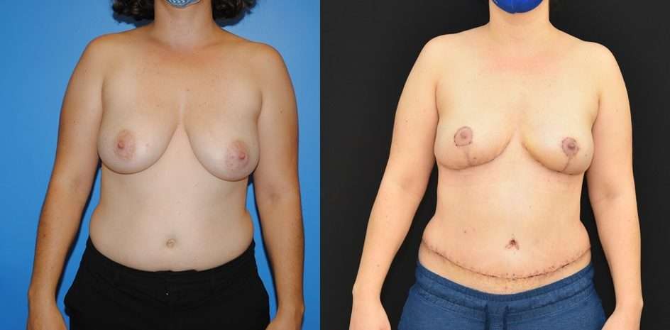 Early DIEP Flap Breast Reconstruction Result