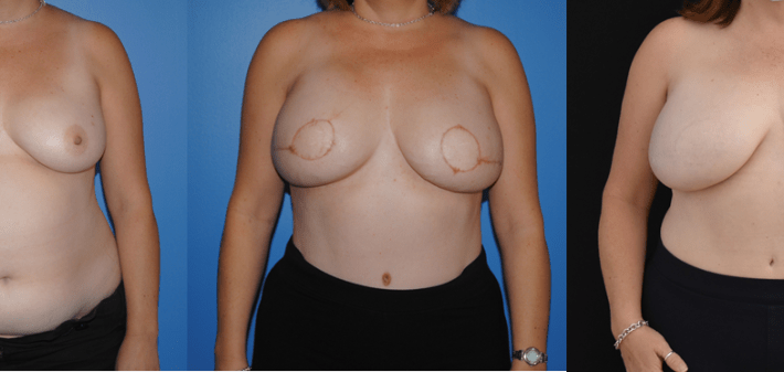 image shows DIEP flap 10 year follow-up with well healed scars