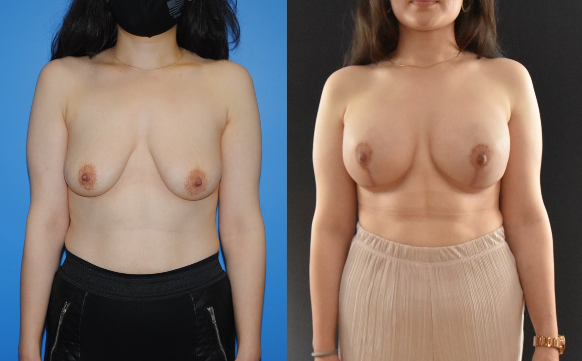 Image shows that a mastectomy reconstruction can appear similar to an aesthetic mastopexy augmentation
